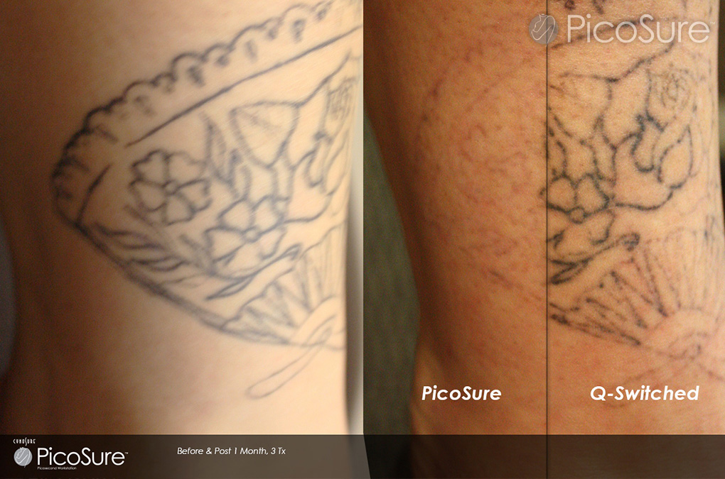 Laser Tattoo Removal | PicoSure | Claritas Laser Clinic