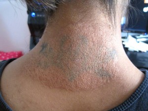 Methods of tattoo removal - Claritas Laser Clinic