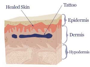 Which is the best tattoo removal method? - Claritas Laser ...