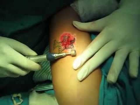 Limited Tattoo Excision  Tattoo Removal Surgery Gainesville Florida